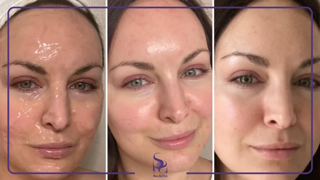 اثرات و مزایای کربوکسی&zwnj; تراپی صورت| اسپا تجهیز