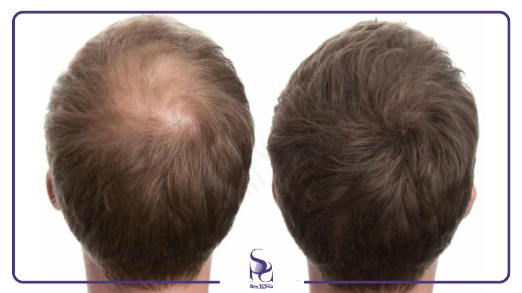 مزایای زیبایی و ظاهری کربوکسی تراپی مو| اسپا تجهیز