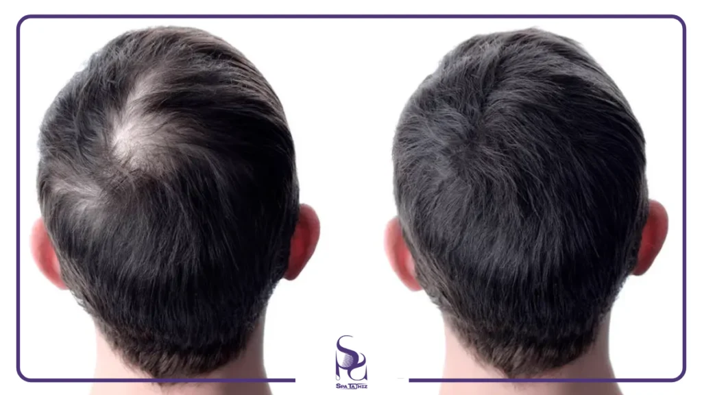 کربوکسی تراپی مو چیست و چگونه عمل می کند؟| اسپا تجهیز