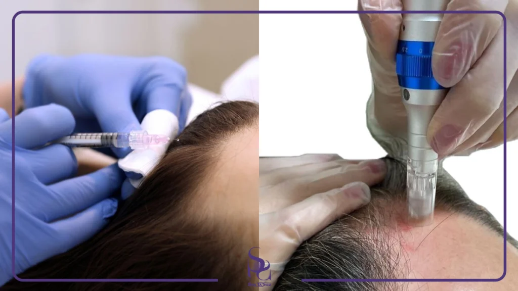 تفاوت کربوکسی تراپی مو با مزوتراپی و PRP| اسپا تجهیز