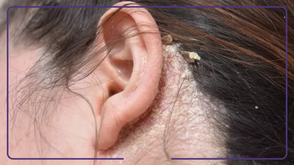 درماتیت سبورئیک چیست و چرا به وجود می آید؟ | اسپا تجهیز